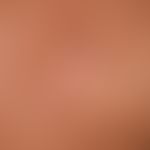 Nodules skin-coloured: flat, wood-like, firm, plate-like nodules protruding above the skin level;...
