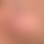 Lupus erythematodes chronicus discoides: zu deutlicher Vernarbung&nbsp;führender CDLE.&nbsp;Atrop...