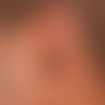 Lupus erythematodes chronicus discoides:&nbsp;unscharf begrenzte, rote und braune, teils leicht s...