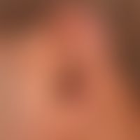 Lupus erythematodes chronicus discoides: blurred, red and brown, partly slightly scaly, partly ve...