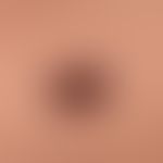 Naevus Spitz: a brown plaque that has existed for several months, flatly protuberant, sharply def...