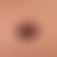 Naevus Spitz: a brown plaque that has existed for several months, flatly protuberant, sharply def...