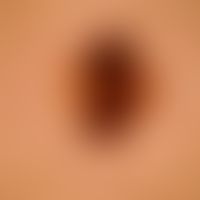 Nevus Spitz. reflected light microscopy of the previously clinically imaged nevus. irregular pigm...