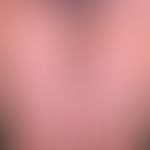 Dermatosis acute febrile neutrophils: acute, exanthematic clinical picture with affection of face...