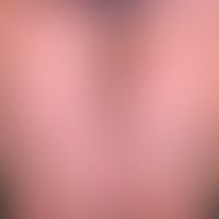 Dermatosis acute febrile neutrophils: acute, exanthematic clinical picture with affection of face...
