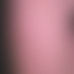 Dermatosis acute febrile neutrophils: acute, exanthematic clinical picture with affection of face...