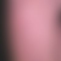 Dermatosis acute febrile neutrophils: acute, exanthematic clinical picture with affection of face...