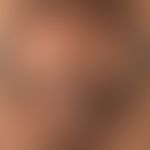 Lupus erythematodes chronicus discoides: ältere&nbsp;nur wenig aktive, unter Atrophie von Haut un...