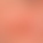 Granuloma faciale: Red-brown, blurred and irregularly configured, symptomless plaque in a 52-year...