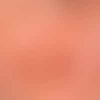 Granuloma faciale: Red-brown, blurred and irregularly configured, symptomless plaque in a 52-year...