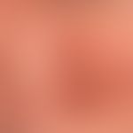 Granuloma faciale: Red-brown, blurred and irregularly configured, symptomless plaque in a 52-year...