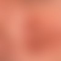 Granuloma faciale: Red-brown, blurred and irregularly configured, symptomless plaque in a 52-year...