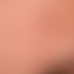 Granuloma faciale: Multiple, reddish-brown, blurred and irregularly configured, symptomless plaqu...