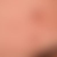 Granuloma faciale: Multiple, reddish-brown, blurred and irregularly configured, symptomless plaqu...