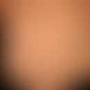 Dermatitis hypereosinophile: seit Monaten bestehendes, heftig juckendes, eher diskretes, stellenw...