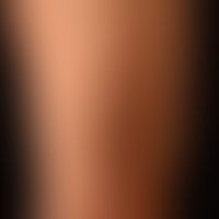 Dermatitis, hypereosinophile: generalisiertes, teils papulöses, teils plaqueartiges, erheblich ju...