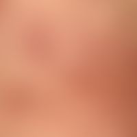 Purpura anularis teleangiectodes: clinical picture that has existed for several months with anula...