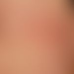 Purpura pigmentosa progressica (type: Purpura anularis teleangiectodes): brown-red anular, by con...