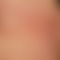 Purpura pigmentosa progressica (type: Purpura anularis teleangiectodes): brown-red anular, by con...