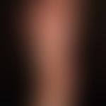 Purpura pigmentosa progressiva: aetiologically unexplained (medication probably) distinct clinica...