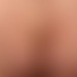 Purpura pigmentosa progressiva: aetiologically unexplained (medication?) pronounced clinical pict...