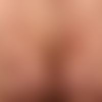 Purpura pigmentosa progressiva: aetiologically unexplained (medication?) pronounced clinical pict...