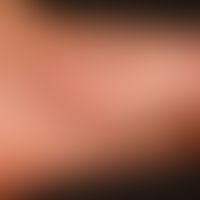 Pyoderma: clinical picture of (non follicular) impetigo contagiosa with medium-sized pustules (de...