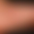 Pustel: nicht follikuläre Pusteln (Nachweis von Staphylokokkus aureus) bei vorbekannter (verwahll...