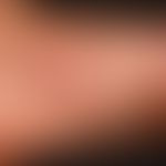 Pustel: nicht follikuläre Pusteln (Nachweis von Staphylokokkus aureus) bei vorbekannter (verwahll...