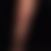 Malformation vaskuläre:&nbsp;Klinisches Bild des Angiokeratoma corporis circumscriptum, einer nic...