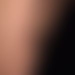 Angiokeratoma corporis circumscriptum: ausgedehnte, lineare (den Blaschko-Linien folgende), nicht...