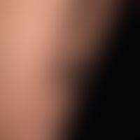 Angiokeratoma corporis circumscriptum: ausgedehnte, lineare (den Blaschko-Linien folgende), nicht...