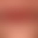Cheilitis kontaktallergische:&nbsp; gespanntes und berührungsempfindliches und deutlich induriert...