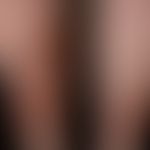 Necrobiosis lipoidica: bilateral, gradually increasing, sharply defined, confluent, reddish-brown...