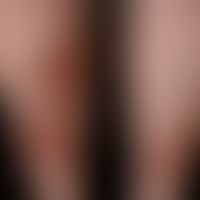 Necrobiosis lipoidica: bilateral, gradually increasing, sharply defined, confluent, reddish-brown...