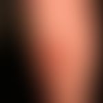 Necrobiosis lipoidica: confluent, reddish-brownish, reddish-brownish, centrally clearly atrophic ...