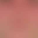 Lupus erythematosus systemic: characteristic lupus mask with persistent, succulent red plaques wi...