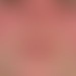 Lupus erythematosus systemic: characteristic lupus mask with persistent, succulent red plaques wi...