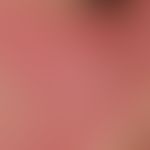 Systemic lupus erythematosus: pronounced findings with bilateral, symmetrical, flat plaque format...