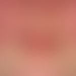 Systemic lupus erythematosus: Pronounced findings with bilateral, symmetrical, flat plaques; flat...