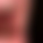 Systemic lupus erythematosus: whitish (lichen planus-like) plaques in the area of the dental ridg...