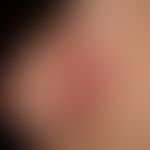Systemic lupus erythematosus: Pronounced findings with bilateral, symmetrical, two-dimensional, a...