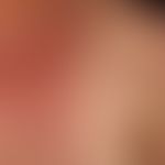 Systemic lupus erythematosus: pronounced findings with bilateral, symmetrical, flat plaque format...
