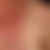Systemic lupus erythematosus: pronounced findings with bilateral, symmetrical, flat plaque format...