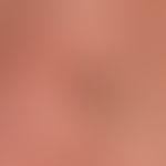 Epidermodysplasia verruciformis: disseminierte und generalisierte Aussaat von flachen (den planen...