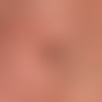 Epidermodysplasia verruciformis: disseminierte und generalisierte Aussaat von flachen (den planen...