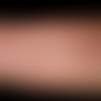 Epidermodysplasia verruciformis: disseminierte und generalisierte Aussaat von flachen (planen War...