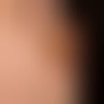 Cornu cutaneum: Cornu cutaneum that has existed for years, is broadly seated and has been in pain...