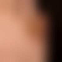 Cornu cutaneum: Cornu cutaneum that has existed for years, is broadly seated and has been in pain...