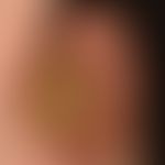 Cornu cutaneum: Cornu cutaneum that has existed for years, is broadly seated and has been in pain...